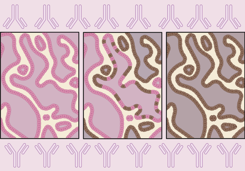 The Role of Immunohistochemistry in Breast Cancer Research