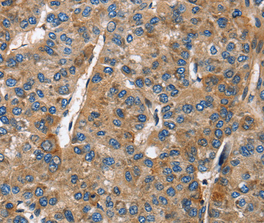 Immunohistochemistry of paraffin-embedded Human liver cancer tissue using BGN Polyclonal Antibody at dilution 1:50