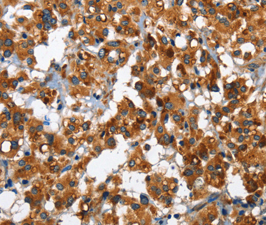 Immunohistochemistry of paraffin-embedded Human thyroid cancer tissue using SLAMF8 Polyclonal Antibody at dilution 1:40