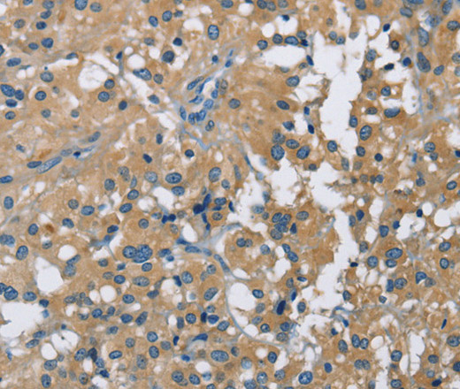 Immunohistochemistry of paraffin-embedded Human thyroid cancer using CAB39L Polyclonal Antibody at dilution of 1:40