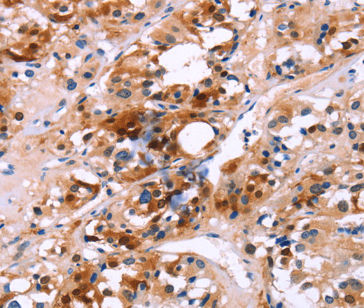 Immunohistochemistry of paraffin-embedded Human thyroid cancer using CALB1 Polyclonal Antibody at dilution of 1:60