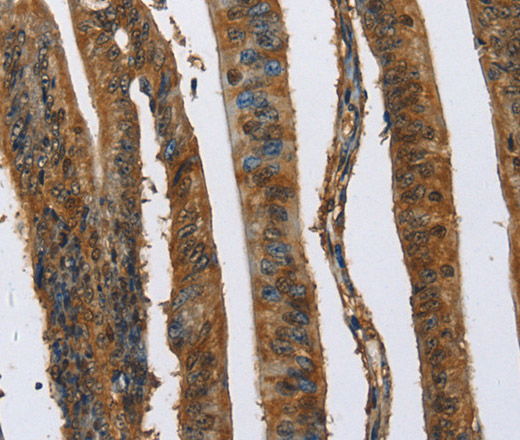 Immunohistochemistry of paraffin-embedded Human colon cancer using CAST Polyclonal Antibody at dilution of 1:70