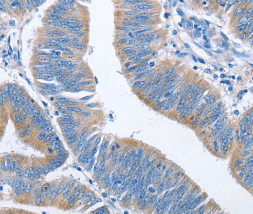 Immunohistochemistry of paraffin-embedded Human colon cancer using NCAPD2 Polyclonal Antibody at dilution of 1:40