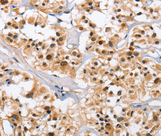 Immunohistochemistry of paraffin-embedded Human thyroid cancer tissue using NCAPD3 Polyclonal Antibody at dilution 1:50