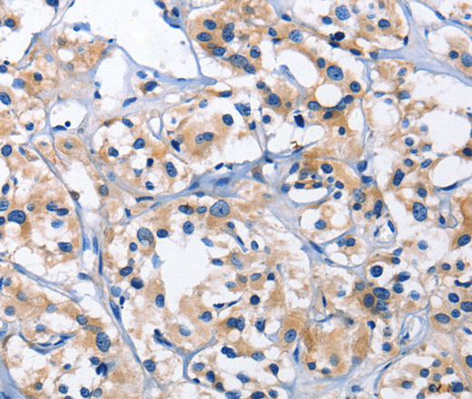 Immunohistochemistry of paraffin-embedded Human thyroid cancer using CAPZA2 Polyclonal Antibody at dilution of 1:30