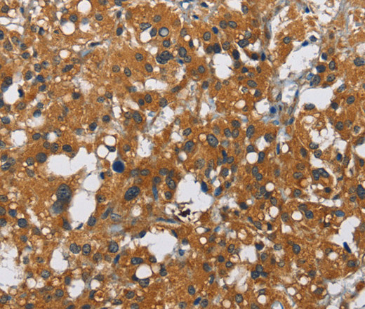 Immunohistochemistry of paraffin-embedded Human thyroid cancer tissue using CARD9 Polyclonal Antibody at dilution 1:70