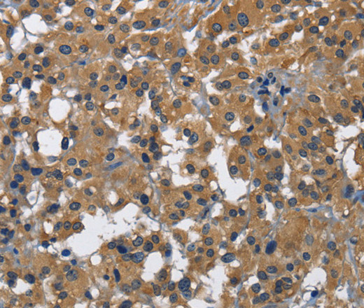 Immunohistochemistry of paraffin-embedded Human thyroid cancer using CD160 Polyclonal Antibody at dilution of 1:30