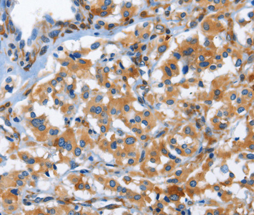 Immunohistochemistry of paraffin-embedded Human thyroid cancer using CD244 Polyclonal Antibody at dilution of 1:50