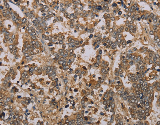 Immunohistochemistry of paraffin-embedded Human liver cancer using NOV Polyclonal Antibody at dilution of 1:25