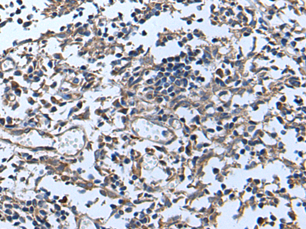 Immunohistochemistry of paraffin-embedded Human tonsil tissue  using APOD Polyclonal Antibody at dilution of 1:55(×200)