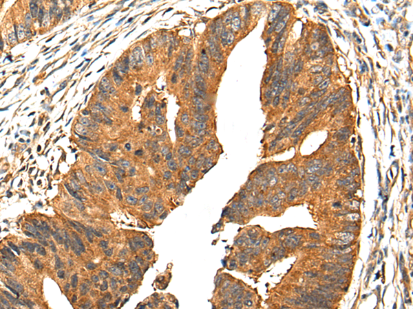 Immunohistochemistry of paraffin-embedded Human colorectal cancer tissue  using PIBF1 Polyclonal Antibody at dilution of 1:30(×200)