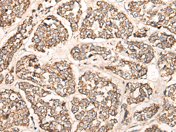 Immunohistochemistry of paraffin-embedded Human esophagus cancer tissue  using C1S Polyclonal Antibody at dilution of 1:55(×200)