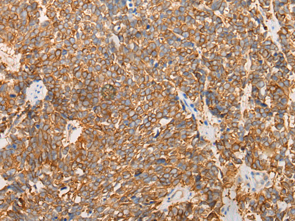 Immunohistochemistry of paraffin-embedded Human lung cancer tissue  using LRRC16A Polyclonal Antibody at dilution of 1:40(×200)