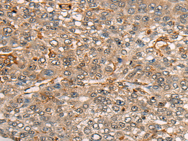 Immunohistochemistry of paraffin-embedded Human liver cancer tissue  using CDT1 Polyclonal Antibody at dilution of 1:45(×200)