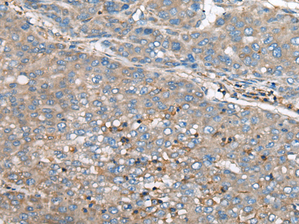 Immunohistochemistry of paraffin-embedded Human liver cancer tissue  using GULP1 Polyclonal Antibody at dilution of 1:65(×200)