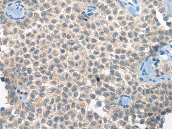 Immunohistochemistry of paraffin-embedded Human ovarian cancer tissue  using CLTCL1 Polyclonal Antibody at dilution of 1:60(×200)