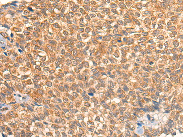 Immunohistochemistry of paraffin-embedded Human ovarian cancer tissue  using UBIAD1 Polyclonal Antibody at dilution of 1:40(×200)