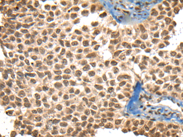 Immunohistochemistry of paraffin-embedded Human ovarian cancer tissue  using XPO1 Polyclonal Antibody at dilution of 1:40(×200)