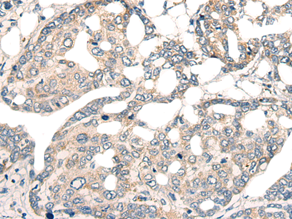 Immunohistochemistry of paraffin-embedded Human liver cancer tissue  using CORO2A Polyclonal Antibody at dilution of 1:45(×200)