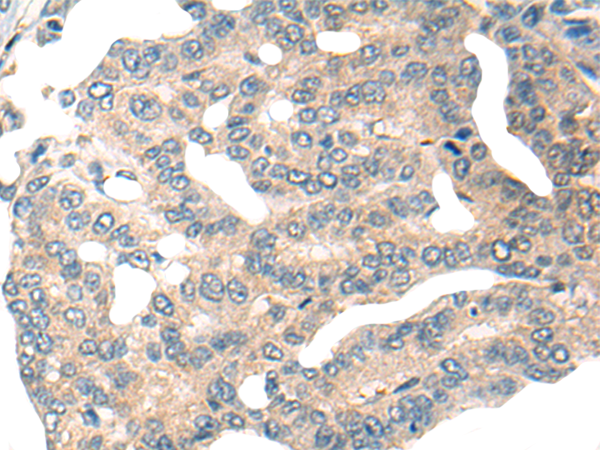 Immunohistochemistry of paraffin-embedded Human liver cancer tissue  using HIPK2 Polyclonal Antibody at dilution of 1:65(×200)