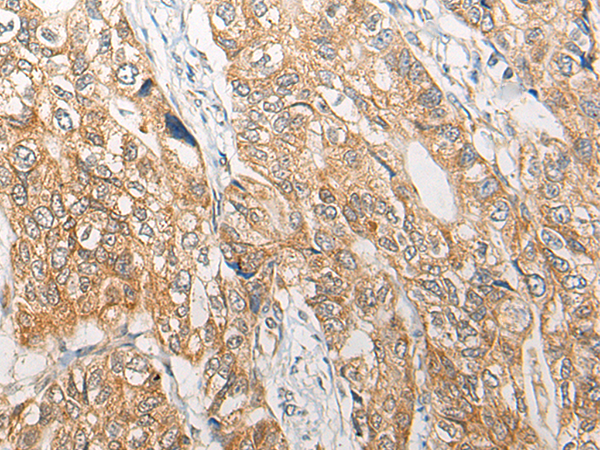 Immunohistochemistry of paraffin-embedded Human gastric cancer tissue  using RGN Polyclonal Antibody at dilution of 1:25(×200)