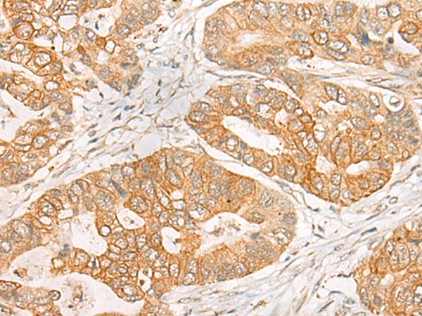 Immunohistochemistry of paraffin-embedded Human gastric cancer tissue  using GNB1L Polyclonal Antibody at dilution of 1:35(×200)