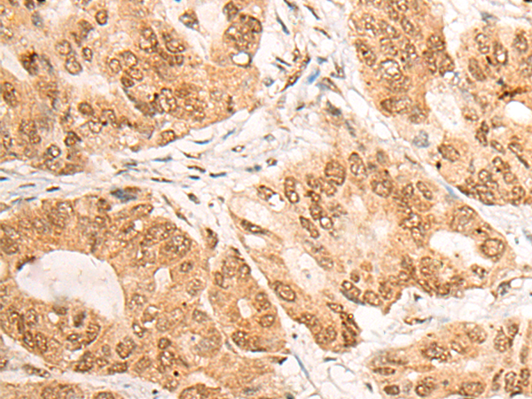 Immunohistochemistry of paraffin-embedded Human gastric cancer tissue  using LPIN1 Polyclonal Antibody at dilution of 1:60(×200)