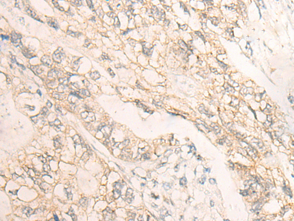 Immunohistochemistry of paraffin-embedded Human gastric cancer tissue  using DMTN Polyclonal Antibody at dilution of 1:35(×200)