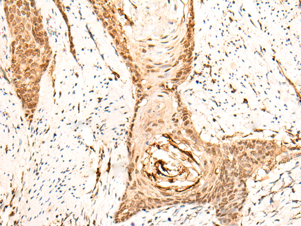 Immunohistochemistry of paraffin-embedded Human esophagus cancer tissue  using EMSY Polyclonal Antibody at dilution of 1:25(×200)