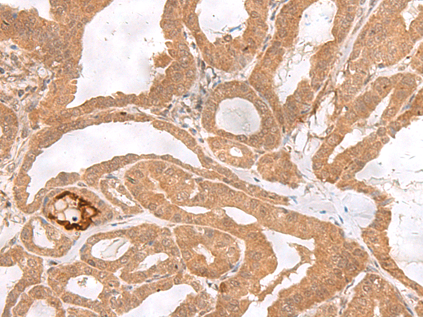 Immunohistochemistry of paraffin-embedded Human thyroid cancer tissue  using ETV3 Polyclonal Antibody at dilution of 1:25(×200)