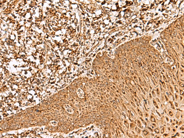 Immunohistochemistry of paraffin-embedded Human esophagus cancer tissue  using FAM200A Polyclonal Antibody at dilution of 1:55(×200)