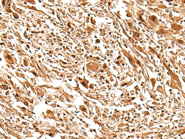 Immunohistochemistry of paraffin-embedded Human liver cancer tissue  using FIZ1 Polyclonal Antibody at dilution of 1:35(×200)