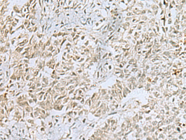 Immunohistochemistry of paraffin-embedded Human ovarian cancer tissue  using FOXQ1 Polyclonal Antibody at dilution of 1:25(×200)