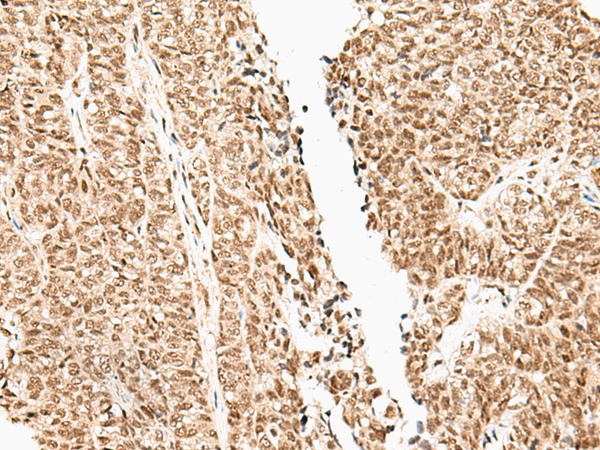 Immunohistochemistry of paraffin-embedded Human ovarian cancer tissue  using FUT3 Polyclonal Antibody at dilution of 1:35(×200)