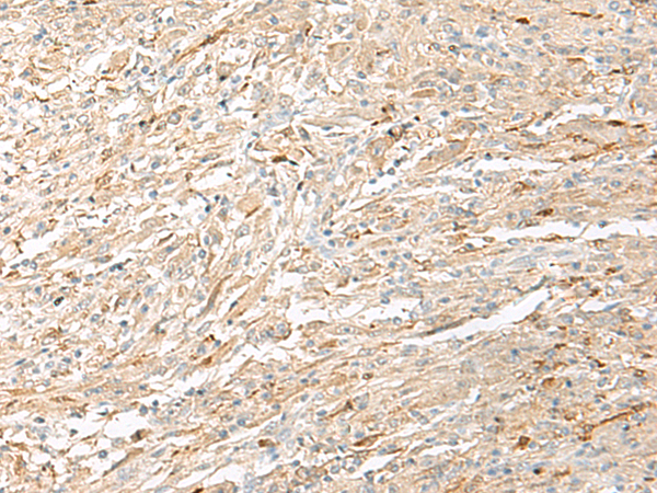 Immunohistochemistry of paraffin-embedded Human liver cancer tissue  using EPRS Polyclonal Antibody at dilution of 1:60(×200)