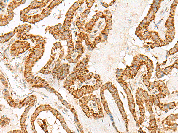 Immunohistochemistry of paraffin-embedded Human thyroid cancer tissue  using NUP210 Polyclonal Antibody at dilution of 1:30(×200)