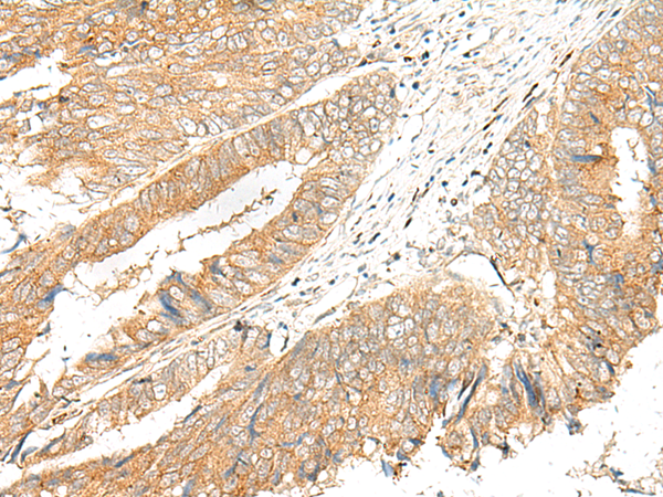 Immunohistochemistry of paraffin-embedded Human colorectal cancer tissue  using GPR151 Polyclonal Antibody at dilution of 1:45(×200)