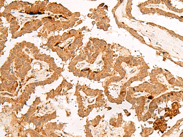 Immunohistochemistry of paraffin-embedded Human thyroid cancer tissue  using POLR2L Polyclonal Antibody at dilution of 1:45(×200)