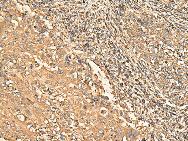 Immunohistochemistry of paraffin-embedded Human cervical cancer tissue  using RPS28 Polyclonal Antibody at dilution of 1:30(×200)