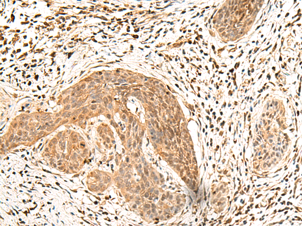 Immunohistochemistry of paraffin-embedded Human esophagus cancer tissue  using LDHA Polyclonal Antibody at dilution of 1:25(×200)