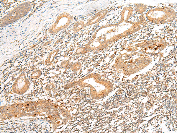 Immunohistochemistry of paraffin-embedded Human esophagus cancer tissue  using HLA-G Polyclonal Antibody at dilution of 1:45(×200)