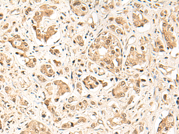 Immunohistochemistry of paraffin-embedded Human prost ate cancer tissue  using GPR139 Polyclonal Antibody at dilution of 1:50(×200)