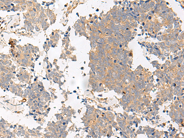 Immunohistochemistry of paraffin-embedded Human lung cancer tissue  using GPR153 Polyclonal Antibody at dilution of 1:40(×200)