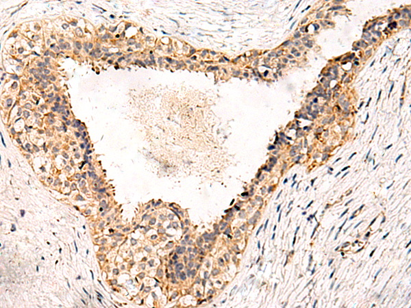 Immunohistochemistry of paraffin-embedded Human breast cancer tissue  using GPR152 Polyclonal Antibody at dilution of 1:55(×200)