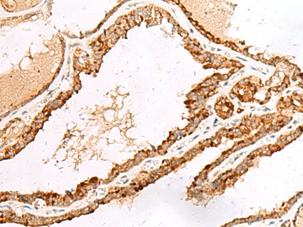 Immunohistochemistry of paraffin-embedded Human thyroid cancer tissue  using LGALSL Polyclonal Antibody at dilution of 1:70(×200)