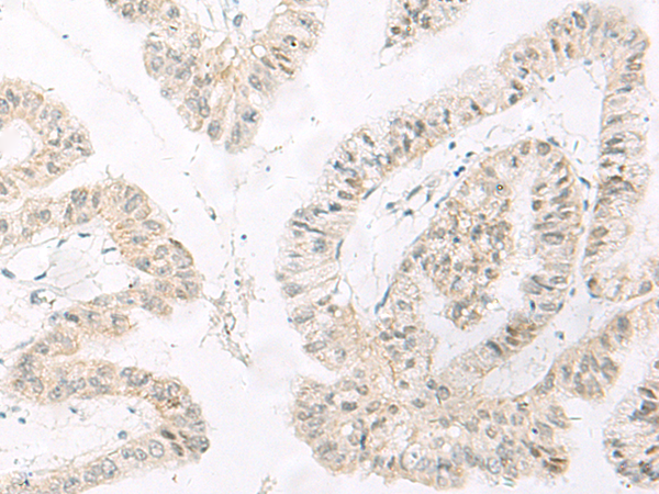 Immunohistochemistry of paraffin-embedded Human liver cancer tissue  using HABP4 Polyclonal Antibody at dilution of 1:60(×200)