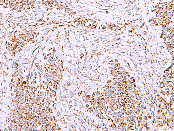 Immunohistochemistry of paraffin-embedded Human ovarian cancer tissue  using HSF2BP Polyclonal Antibody at dilution of 1:30(×200)