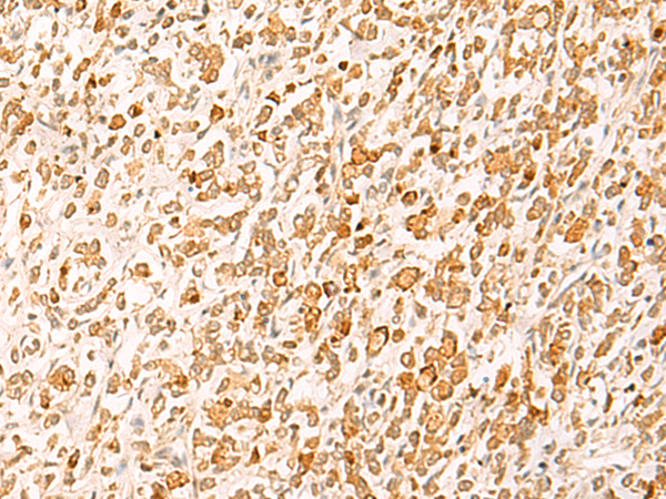 Immunohistochemistry of paraffin-embedded Human gastric cancer tissue  using HTT Polyclonal Antibody at dilution of 1:25(×200)