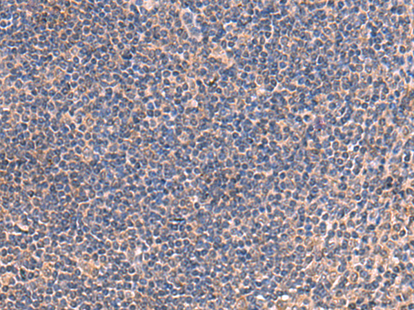 Immunohistochemistry of paraffin-embedded Human tonsil tissue  using IP6K2 Polyclonal Antibody at dilution of 1:45(×200)