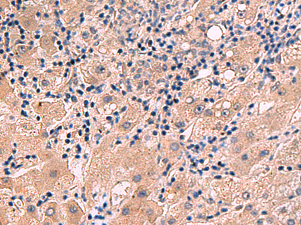 Immunohistochemistry of paraffin-embedded Human liver cancer tissue  using INSM2 Polyclonal Antibody at dilution of 1:35(×200)